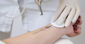 Does tattoo removal leave scars? Find the truth