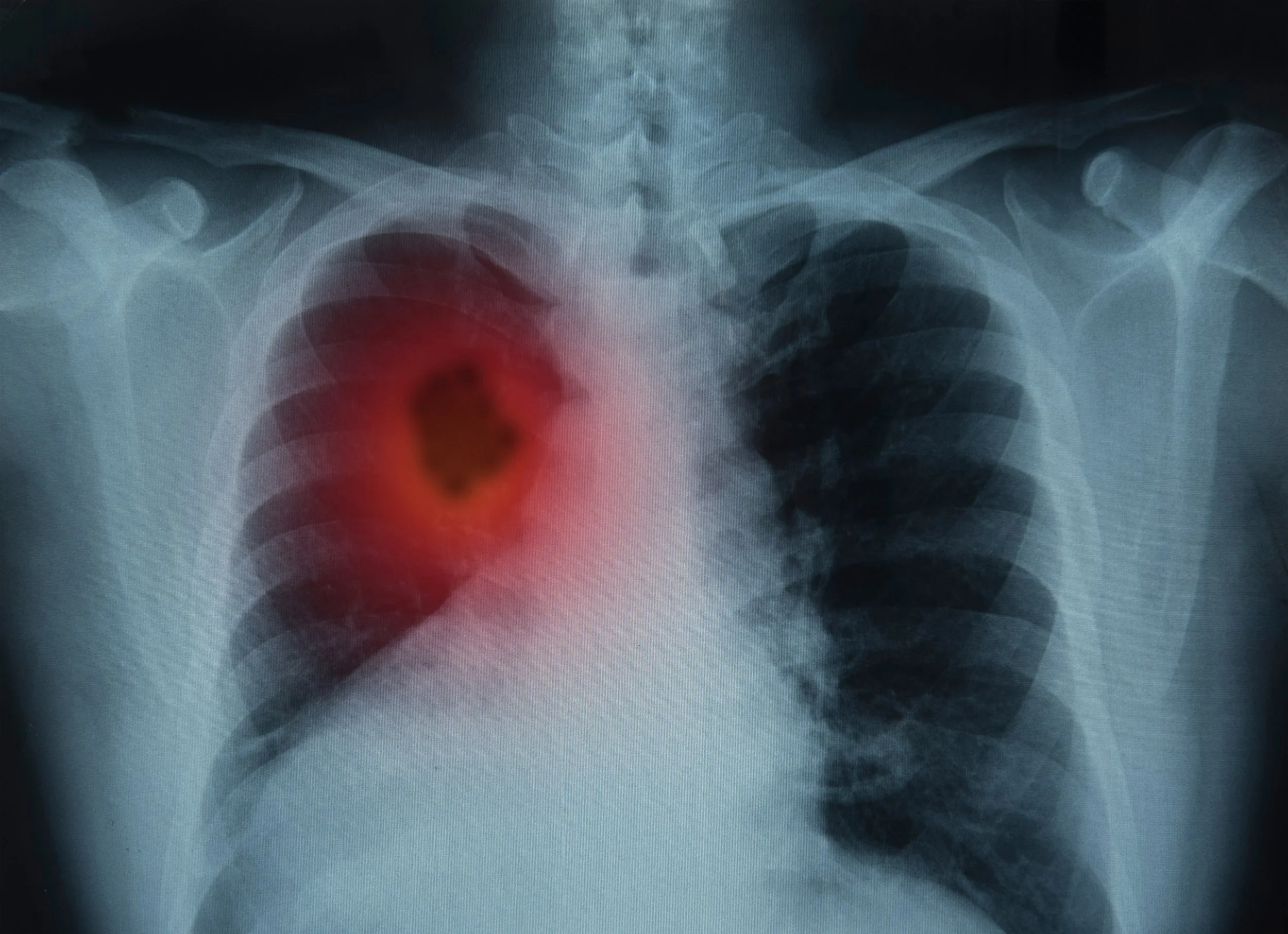 Early Lung Cancer Detection: What You Need to Know