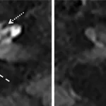 Endolymphatic Hydrops MRI: Unlocking Diagnosis and Care Endolymphatic Hydrops MRI: Unlocking Diagnosis and Care