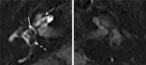 Endolymphatic Hydrops MRI: Unlocking Diagnosis and Care