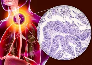 Esophageal Adenocarcinoma Treatment: What to Expect