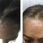 Follicular Lymphoma Treatment: Options, Risks, and Hope Follicular Lymphoma Treatment: Options, Risks, and Hope