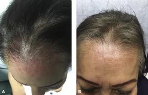 Follicular Lymphoma Treatment: Options, Risks, and Hope