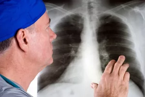 Understanding Lung Cancer Risks: What You Need to Know