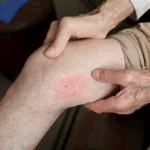 Blood Clot Symptoms: Listen to What Your Body Says