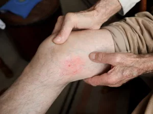 Blood Clot Symptoms: Listen to What Your Body Says