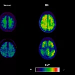 Neuroinflammation PET Scan: Quick Answers & Practical Guide Neuroinflammation PET Scan: Quick Answers & Practical Guide