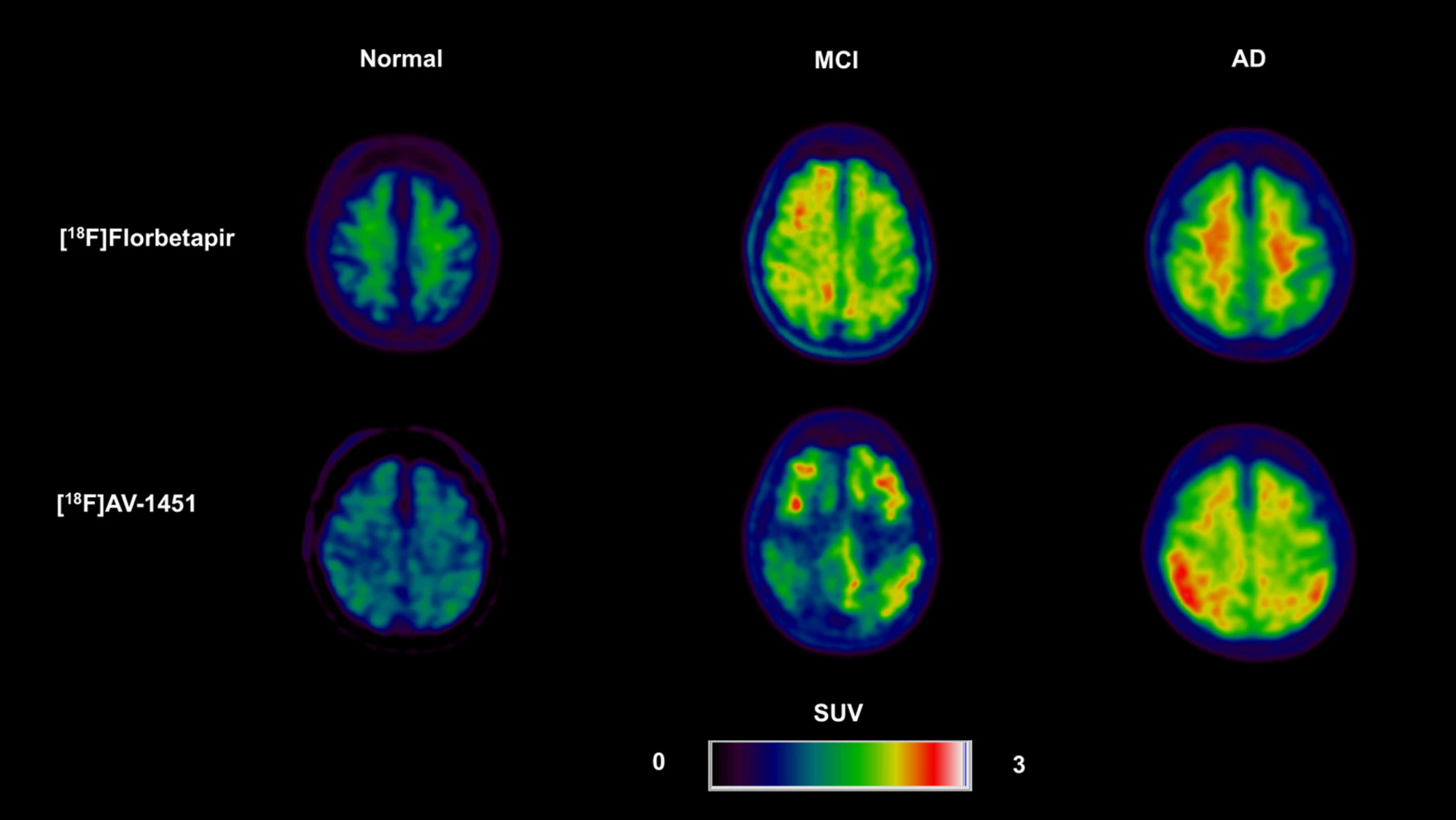 Neuroinflammation PET Scan: Quick Answers & Practical Guide
