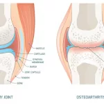 Osteoarthritis Health Risks — What They Mean for You Osteoarthritis Health Risks — What They Mean for You