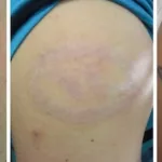 Raised Tattoo Scarring: Causes, Treatment & Prevention