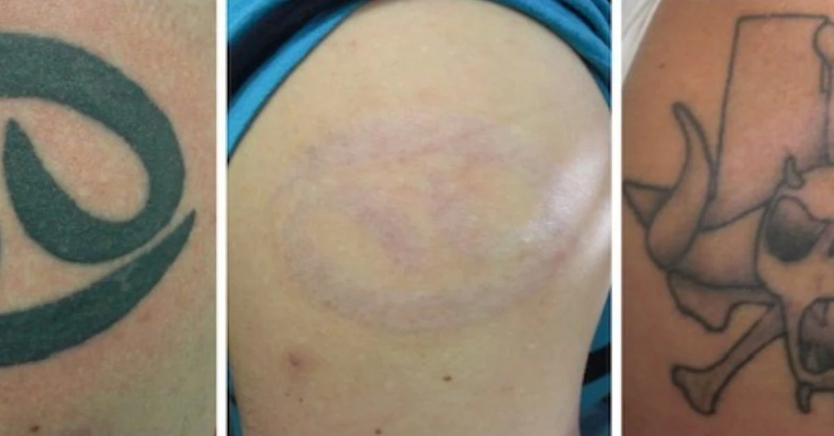 Raised Tattoo Scarring: Causes, Treatment & Prevention