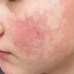 Rubella Dangers: Risks, Complications & Prevention Rubella Dangers: Risks, Complications & Prevention