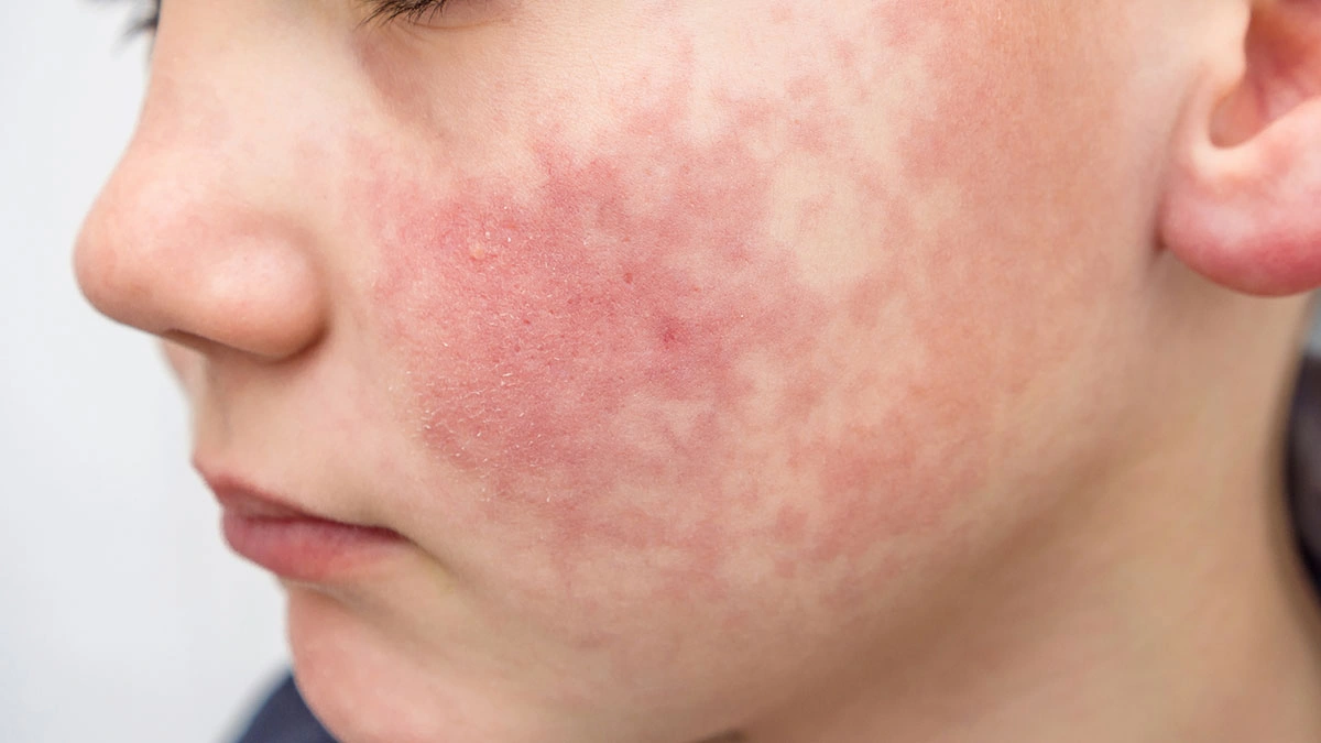 Rubella Dangers: Risks, Complications & Prevention