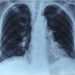 How to Master Shrinking Lung Tumors: A Friendly Guide How to Master Shrinking Lung Tumors: A Friendly Guide