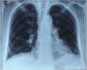 How to Master Shrinking Lung Tumors: A Friendly Guide