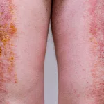 Painful Dermatologic Diseases: Finding Relief & Hope Painful Dermatologic Diseases: Finding Relief & Hope