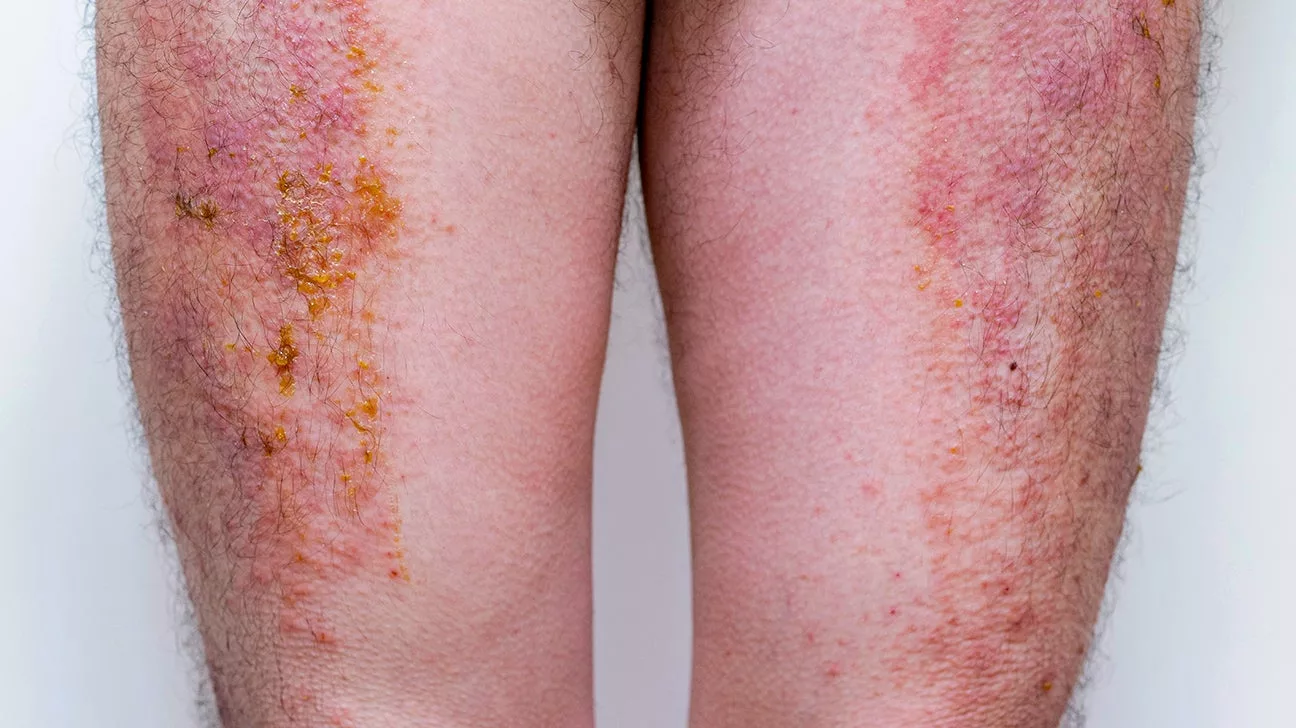 Painful Dermatologic Diseases: Finding Relief & Hope