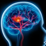 Sickle Cell Stroke Risk: Essential Facts & Prevention