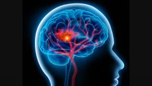 Sickle Cell Stroke Risk: Essential Facts & Prevention