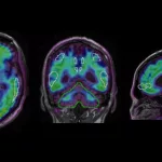 PET Imaging Brain Inflammation: Why It Matters to You PET Imaging Brain Inflammation: Why It Matters to You