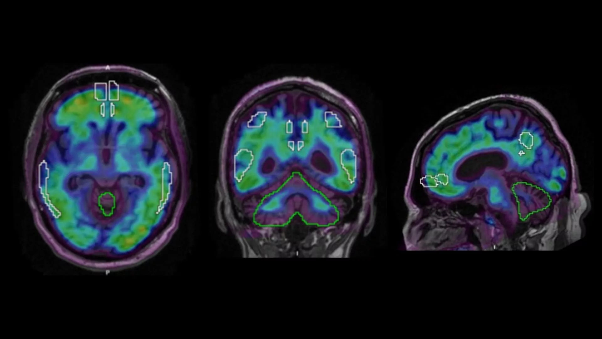 PET Imaging Brain Inflammation: Why It Matters to You