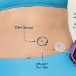 Automated Insulin Delivery: What It Is & How It Works