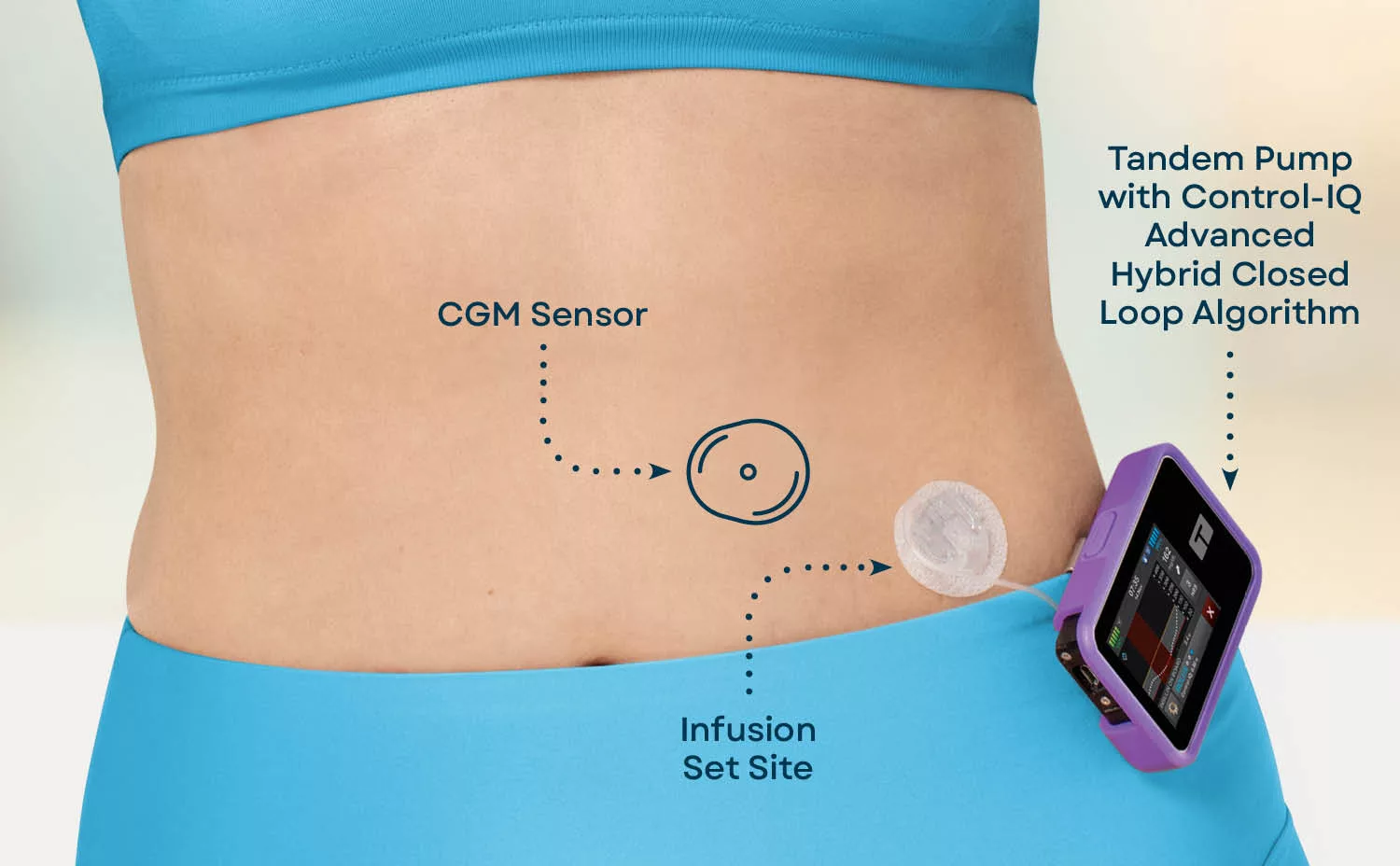 Automated Insulin Delivery: What It Is & How It Works