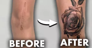 Tattoo Scarring: How to Spot, Prevent & Treat It