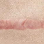 Tattoo Scarring While Healing: Normal Signs & Treatment