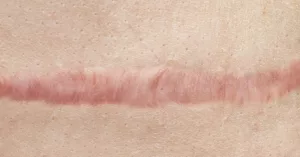 Tattoo Scarring While Healing: Normal Signs & Treatment Tattoo Scarring While Healing: Normal Signs & Treatment