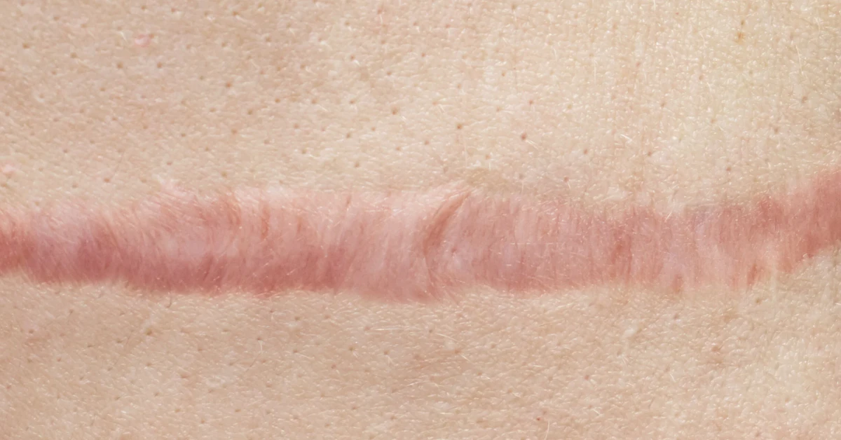 Tattoo Scarring While Healing: Normal Signs & Treatment