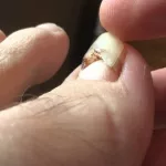 Toenail Falling Off? What to Do Now
