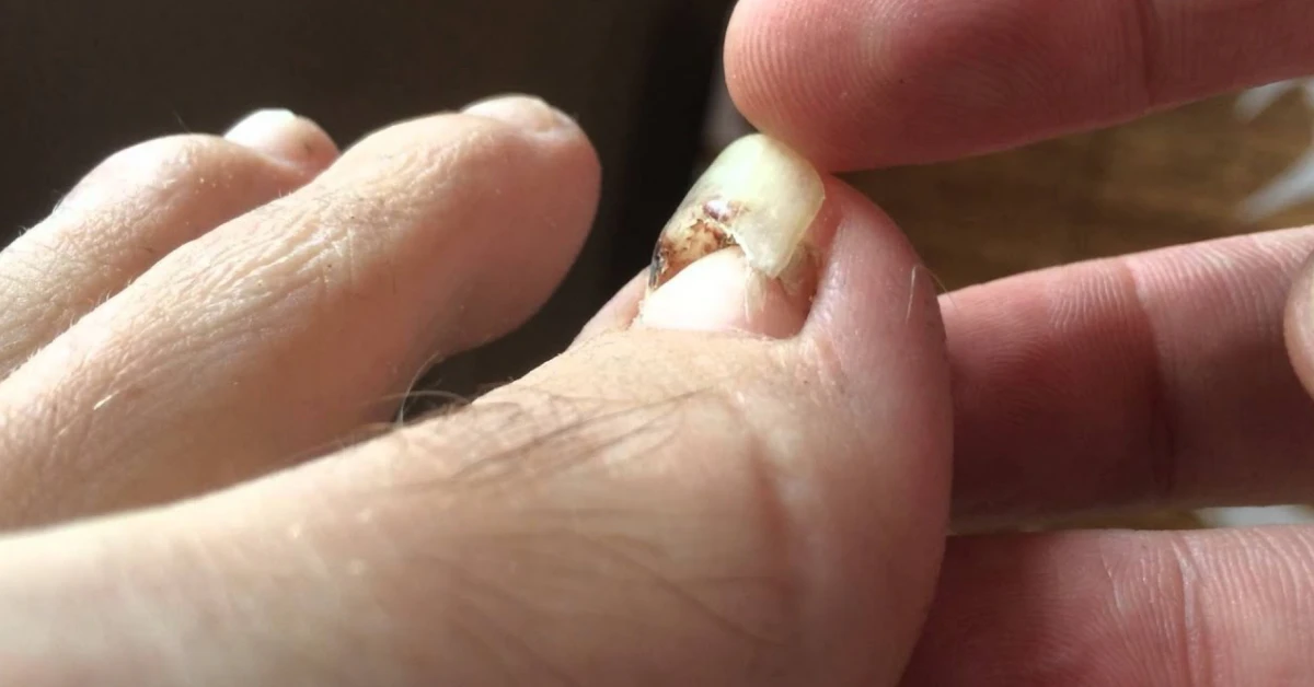 Toenail Falling Off? What to Do Now