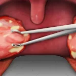 Tonsil Removal Age Limit: When Is It Right?