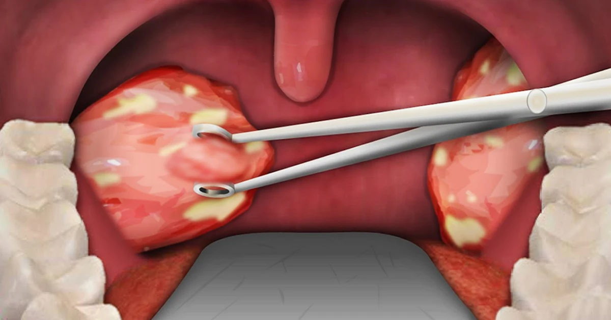 Tonsil Removal Age Limit: When Is It Right?