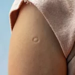 Tuberculosis Vaccine Cancer: New Research Highlights Tuberculosis Vaccine Cancer: New Research Highlights