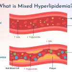 What Is Mixed Hyperlipidemia? Quick Answers & Guidance What Is Mixed Hyperlipidemia? Quick Answers & Guidance