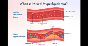 What Is Mixed Hyperlipidemia? Quick Answers & Guidance