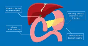 Longest Life After Whipple Surgery: Real Stories And Facts