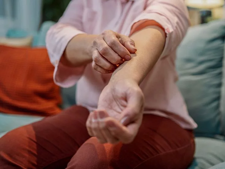 Is Your Lupus Rash Itchy? Find Answers & Relief Today