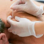 Acupuncture for Neuropathy: Real Relief & What to Expect