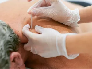 Acupuncture for Neuropathy: Real Relief & What to Expect