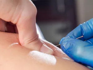 Medicare Dry Needling Coverage: What You Need to Know