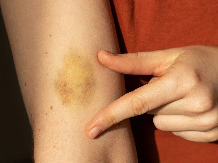 Easy Bruising & Hyperthyroidism: What Really Happens?