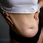 Body Dysmorphia After Weight Loss: How to Cope & Thrive