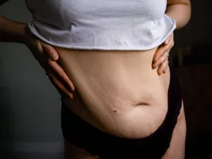 Body Dysmorphia After Weight Loss: How to Cope & Thrive