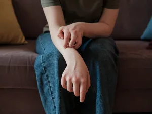 Urticarial Vasculitis: Symptoms, Causes & Treatment