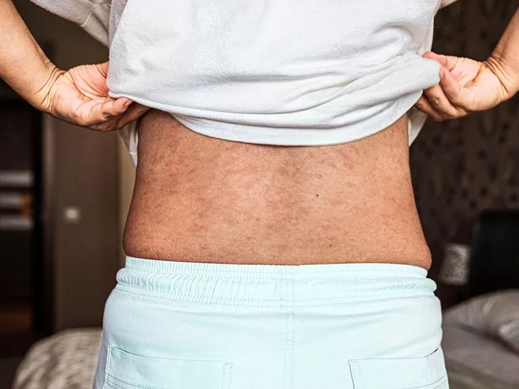 Subacute Cutaneous Lupus: Clear Answers and Guidance