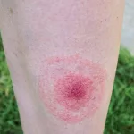 Erythema migrans vs erythema multiforme: Quick Guide