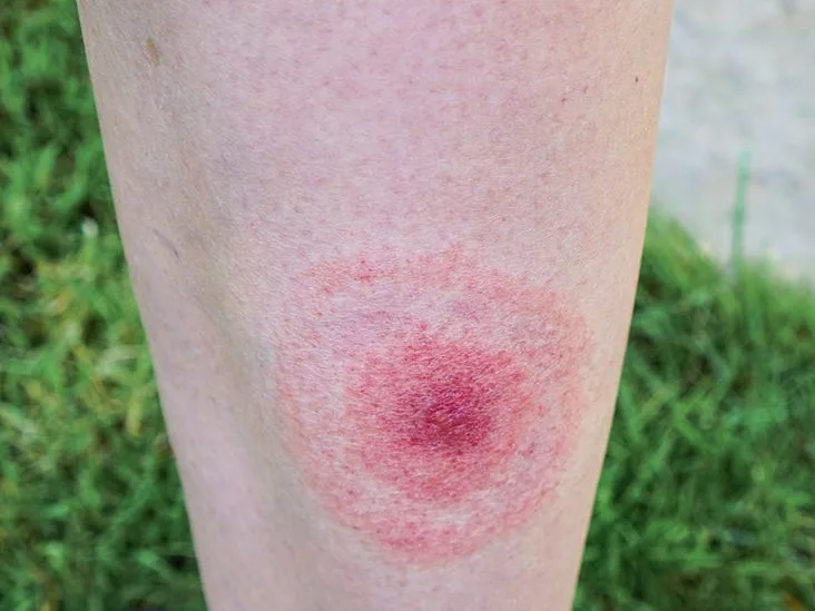 Erythema migrans vs erythema multiforme: Quick Guide